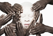 Albinism: Justin Dingwall Justin Dingwall Albus